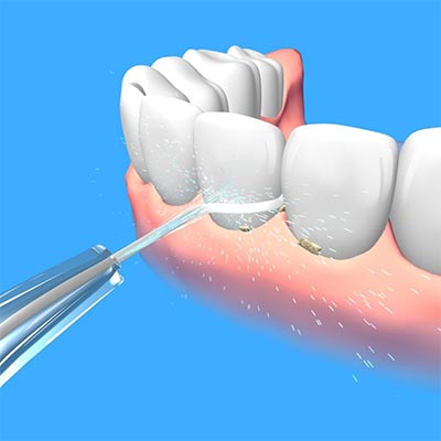 drawing of a water flosser cleaning front teeth